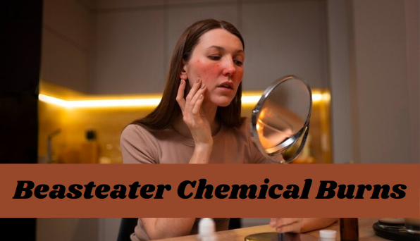 Beasteater Chemical Burns